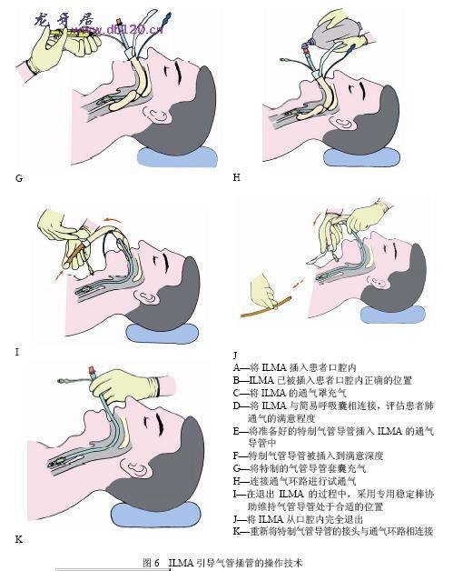 气管插管操作过程详解，视频教程、应用与重要性探讨